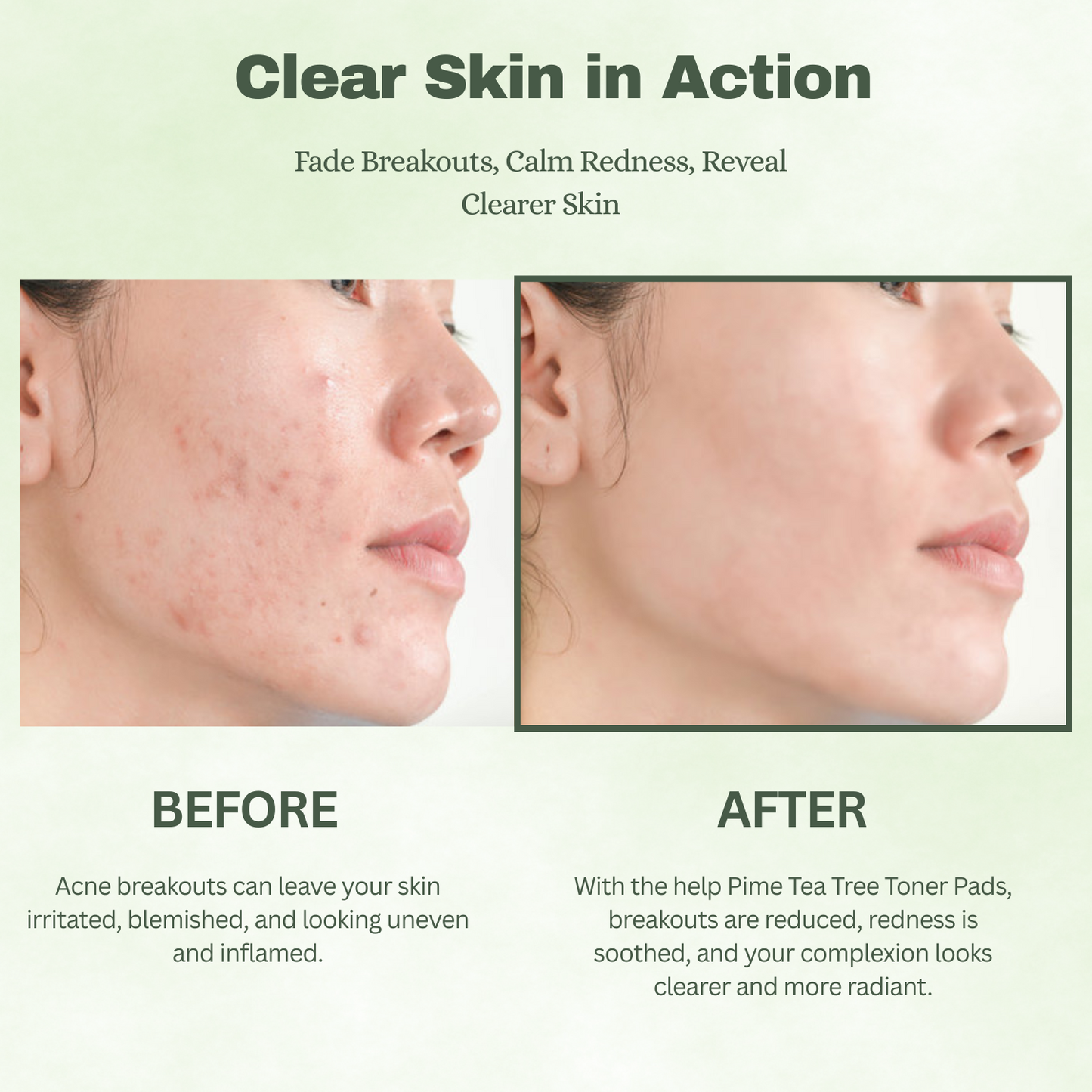 Tea Tree Toner Pads Soothing and Hydrating Toner