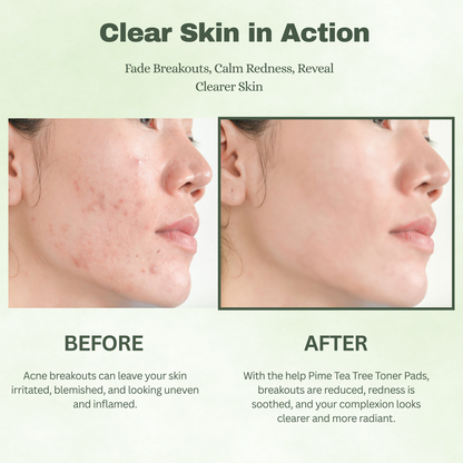 Tea Tree Toner Pads Soothing and Hydrating Toner
